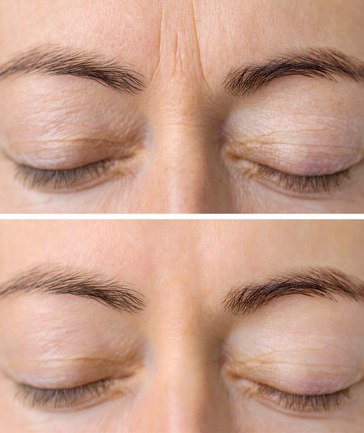 botox botox